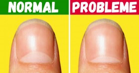 13 probleme de sănătate, pe care ni le dezvăluie forma semilunii de pe unghii